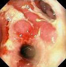 Гастроскопия: эррозивно-язвенный анастомозит. фото 2.