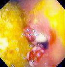 Гастроскопия: стеноз гастроэнтероанастомоза. В области стенозированного анастомоза имеются полиповидные гранулемы, расположенные вокруг шовного материала.