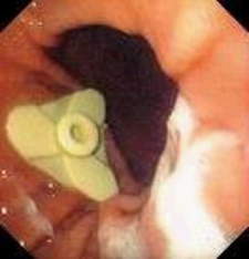Гастроскопия: гастростомический зонд расположен на передней стенке желудка. фото 2.
