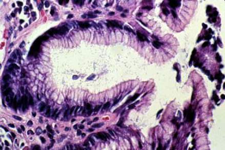 В просветах ямок H. pylori обычно лежат свободно, не соединяясь с выстилающим их эпителием (микропрепарат).