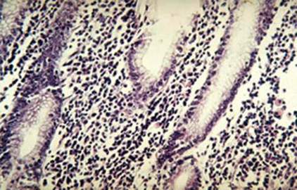 Хронический неатрофический гастрит: выраженная лейкоцитарная реакция эпителия и собственной пластинки на фоне кишечной метаплазии (микропрепарат).