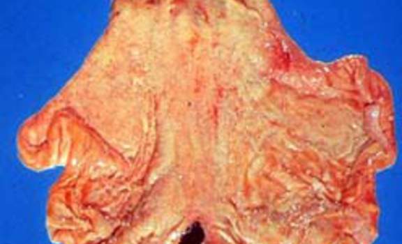 Острая язва желудка с дном черного цвета на фоне острого гастрита (макропрепарат).