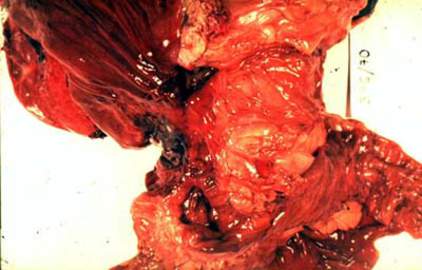Озлокачествившаяся язва желудка, морфологические признаки которой остаются и после малигнизации и отличают язву-рак от рака-язвы (макрорпарат).