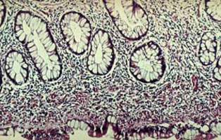 Хронический гастрит: неполная кишечная метаплазия (бокаловидные и призматические слизистые клетки, отсутствие каемчатых энтероцитов и клеток Панета) на фоне выраженной лейкоцитарной реакции (микропрепарат).