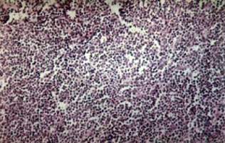 Мальтома желудка с низкой степенью злокачественности: диффузный инфильтрат из лимфоцитов с примесью плазматических клеток (микропрепарат).