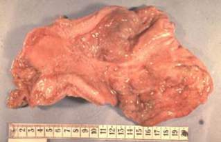 Скирр (фиброзный рак) желудка: явное преобладание стромы над паренхимой опухоли обусловливает характерный внешний вид (значительно утолщенные стенки, их плотность и регидность) органа (макропрепарат).