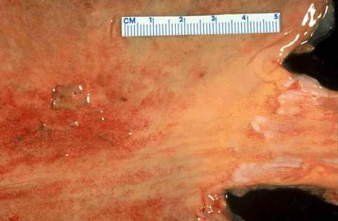 Острая язва желудка (1 см) расположенная в области дна. Язва мелкая и четко отграниченная с перифокальной гиперемией (макропрепарат).