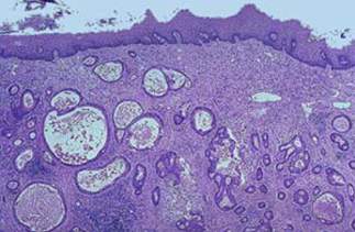 Средне дифференцированная аденокарцинома желудка инфильтрирующая подслизистый слой ниже сквамозной слизистой пищевода. Железы в опухоли имеют различные размеры (микропрепарат).