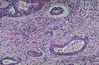 При большом увеличении, в опухолевых клетках желез аденокарциномы желудка обнаруживаются митозы, увеличение соотношения ядро/цитоплазма и гиперхроматизм. Вокруг измененных желез продемонстрирована стромальная реакция (микропрепарат).