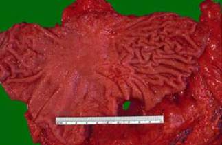 В центральной части изображения находится язва желудка: она не глубокая и имеет размер от 2 до 4 см. В результате биопсии этой язвы была выявлена ее малигнизация и желудок был резицирован (макропрепарат).