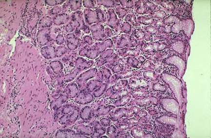 Аденокарцинома желудка: клетки опухоли формируют железистые образования различной формы и величины (микропрепарат).