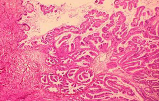 Рак желчных протоков. А. Высокодифференцированная карцинома общего печеночного протока; микропрепарат.