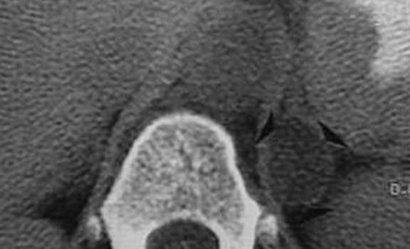Аденомы надпочечников. Компьютерная томография: изображение гиподенсной аденомы левого надпочечника содержит псевдожидкостной компонент размером 27 мм.