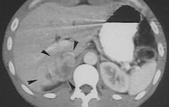 Феохромоцитомы надпочечников. Компьютерная томография: типичный вид феохромоцитомы правого надпочечника с признаками гиперваскуляризации и зонами некроза.