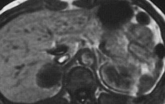 Феохромоцитомы надпочечников. А. Ядерно-магнитная томография (T1): гомогенное опухолевидное образование правого надпочечника гипоинтенсивное по сравнению с печенью - феохромоцитома.
