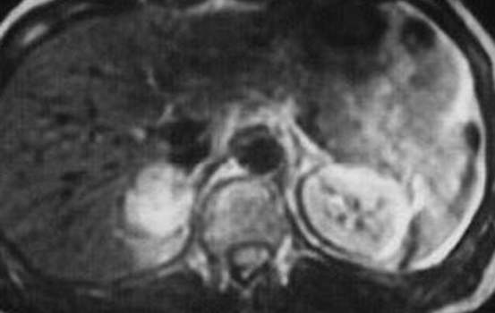 Феохромоцитомы надпочечников. Б. Ядерно-магнитная томография (T2): гетерогенное образование правого надпочечника гиперинтенсивное по сравнению с печенью (тот же случай, что на предыдущем рисунке А.).