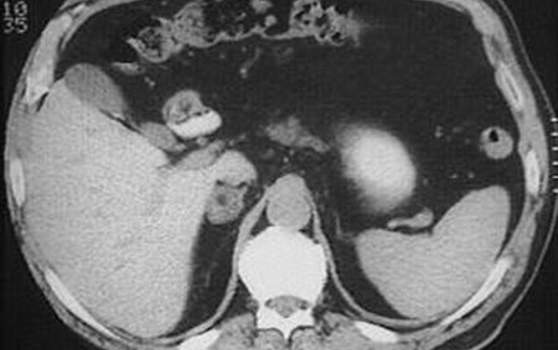 Другие доброкачественные опухоли надпочечников. Ядерно-магнитная томография (T1): гомогенное образование правого надпочечника с ровными четкими контурами, гипоинтенсивное по сравнению с печенью.
