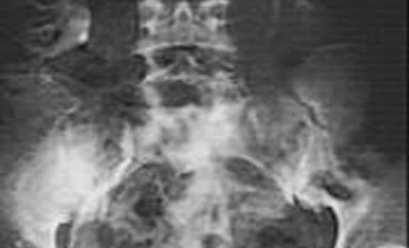 Первичные злокачественные опухолинадпочечников. Рентгенография: образование левого надпочечника с ровным четким контуром и кальцификатами в стенке, центральная часть опухоли содержит полость с жидкостью.