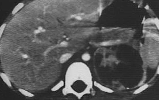 Первичные злокачественные опухолинадпочечников. Компьютерная томография: хорошо отграниченное, гетерогенное образование надпочечника с зонами некроза – ганглионейробластома.