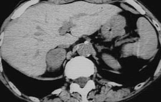 Метастатическое поражение надпочечников. Компьютерная томография: опухолевидное образование правого надпочечника диаметром 3 см - метастаз бронхопульмонарного рака; левый надпочечник не изменен.