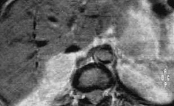 Метастатическое поражение надпочечников. Ядерно-магнитная томография: образование правого надпочечника гиперинтенсивное по отношению к изображению печени и изоинтенсивное по отношению к жировой клетчатке.