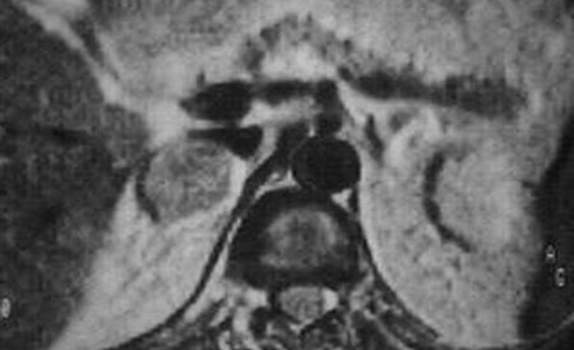 Метастатическое поражение надпочечников. Ядерно-магнитная томография (Т2): опухоль гиперинтенсивная по сравнению с плотностью печени - метастаз бронхопульмонального рака.