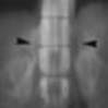 Неизмененные надпочечники. Рентгенография: в проекционной зоне над верхним полюсом соответствующей почки визуализируются надпочечники; правый надпочечник визуализирован лучше.
