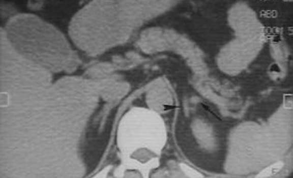 Неизмененные надпочечники. Компьютерная томография: проксимальное расположение селезеночной артерии может симулировать опухолевидное образование левого надпочечника, однако высокая плотность артерии обеспечивает ее уверенную идентификацию.