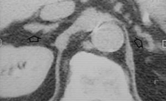 Гиперплазия надпочечников. А. Компьютерная томография: типичная картина при первичном гиперальдостеронизме - узловая гиперплазия обоих надпочечников, контуры которых бугристые.