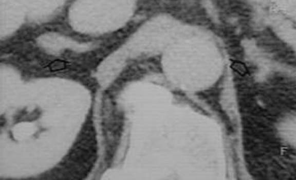 Гиперплазия надпочечников. Б. Компьютерная томография: при сканировании на другом уровне (тот же случай, что и на рисунке предыдущем рисунке А.) хорошо видны «выросты» правого надпочечника.