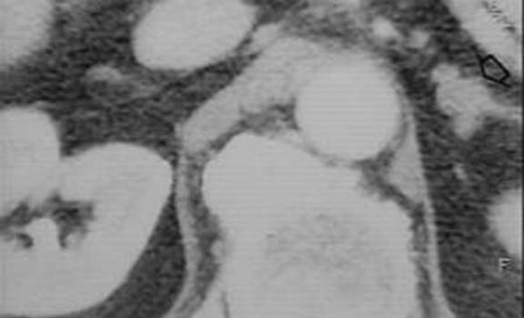 Гиперплазия надпочечников. Компьютерная томография: правый надпочечник отчетливо визуализирован, на этом уровне сканирования средняя часть левого надпочечника представлена узловым образованием, изоденсным ткани надпочечника и соответствующим его гиперпла