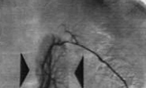 Гиперплазия надпочечников. Флебография левого надпочечника: типичные проявления гиперплазии с округлением контура железы и ее гиперваскуляризацией.