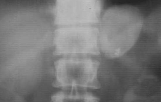 Кальцинаты надпочечников. Рентгенография: двухсторонняя гематома надпочечников - образование в проекции правого надпочечника, оттесняющее правую почку, имеет кальцифицированную стенку; с левой стороны кальцификаты находятся непосредственно в надпочечнике