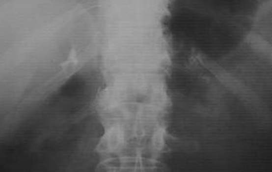 Кальцинаты надпочечников. Рентгенография: кальцификаты надпочечника при его гипертрофии и синдроме недостаточности функции надпочечников.