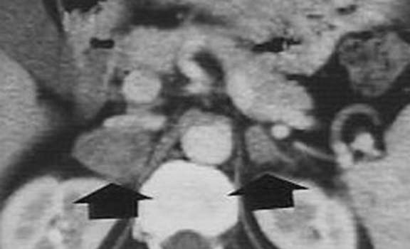 Туберкулез надпочечников. Компьютерная томография: правый надпочечник имеет т.н. «псевдотуморозный» вид, его плотность гетерогенна, ткань накапливает контрастное вещество, в особенности по периферии; левый надпочечник немного гипертрофирован без значител