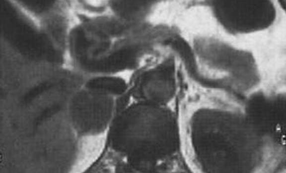 Аденомы надпочечников. А. Ядерно-магнитная томография: гомогенный, гиподенсный по сравнению с печенью опухолевый узел.