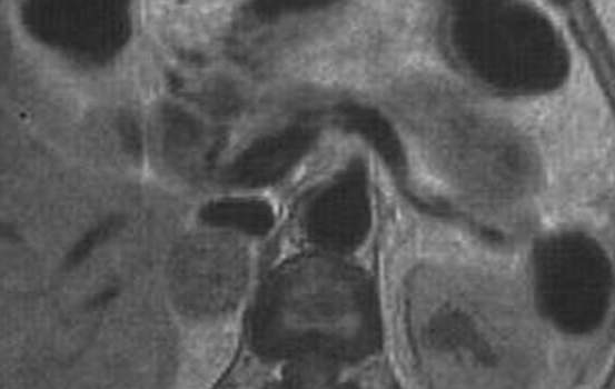 Аденомы надпочечников. Б. Ядерно-магнитная томография: гомогенный, гиподенсный по сравнению с печенью опухолевый узел.