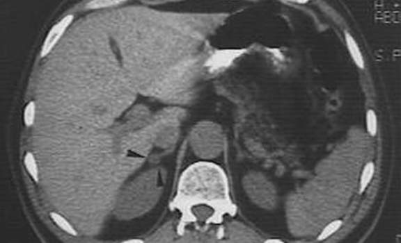 Аденомы надпочечников. Компьютерная томография: небольшой (менее 10 мм) опухолевый узел правого надпочечника, который отчетливо виден, несмотря на его изоденсный характер.