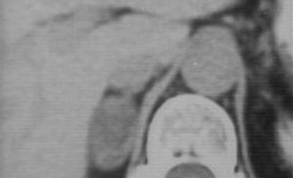 Аденомы надпочечников. Компьютерная томография: опухолевидное образование в правом надпочечнике накапливает контрастное вещество, что свидетельствует о его повышенной васкуляризации - аденома надпочечника.