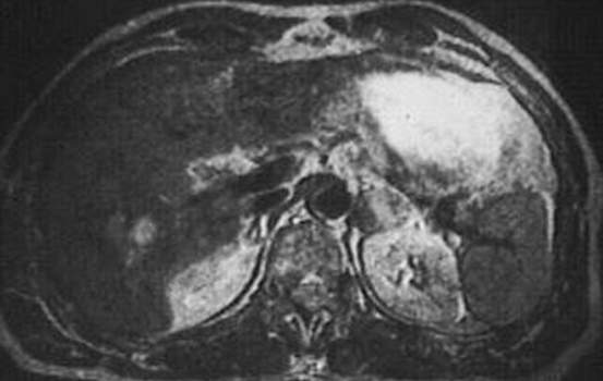 Аденомы надпочечников. А. Ядерно-магнитная томография (T2, 1-е эхо): гетерогенное образование правого надпочечника с небольшими зонами гиперсигнала; в целом плотность опухоли превышает плотность печени.