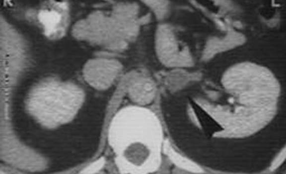 Аденомы надпочечников. А. Компьютерная томография: типичный вид аденомы надпочечника в виде образования небольшого размера (12 мм), расположенного на уровне нижней части левого надпочечника.