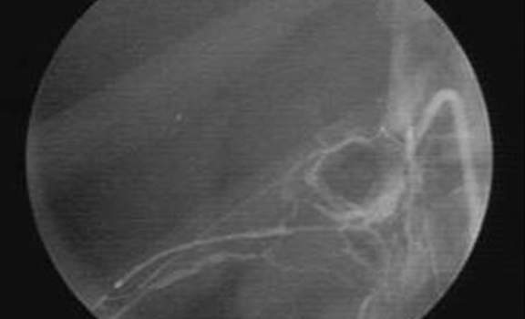 Аденомы надпочечников. Флебографическая картина, характерная для доброкачественной опухоли надпочечника, диаметр опухоли 10 мм.