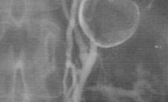Аденомы надпочечников. Флебография левого надпочечника: на верхнем полюсе интраадренальные вены сдавлены, что является типичным проявлением аденомы органа.