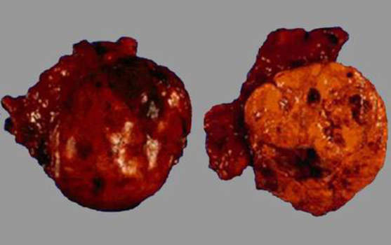 Аденомы надпочечников. Аденома коркового слоя надпочечника: слева - внешняя поверхность аденомы; справа - большое ярко желтое образование с очаговыми кровоизлияниями. Нормальной ткани коркового или мозгового вещества не определяется; макропрепарат.