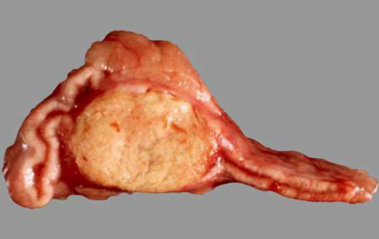 Аденомы надпочечников. Аденома левого надпочечника диаметром 1,3 см, обнаруженная у пациента с гипертензией и гипокалиемией (синдром Конна); макропрепарат.