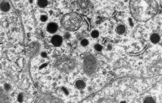 Феохромоцитома. Электронная микроскопия: опухолевые клетки феохромоцитомы содержат нейросекреторные гранулы, в которых находится катехоламины.