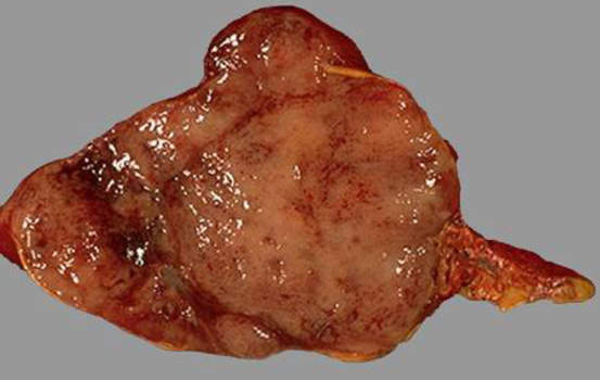 Феохромоцитома. Феохромоцитома надпочечника, поперечный разрез: поверхность опухоли с полями кровоизлияний является типичной; макропрепарат.