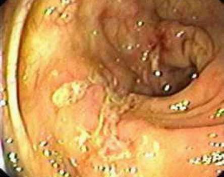 Колоноскопия: вид слизистой оболочки сигмовидной кишки при болезни Крона