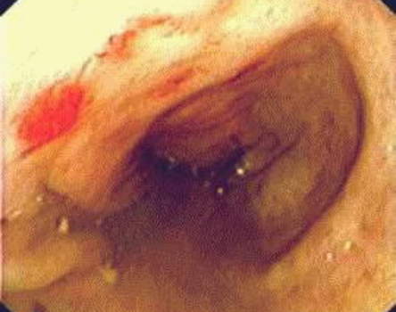 Ректоскопия: ограниченный участок гиперемии слизистой оболочки прямой кишки при лучевом проктите