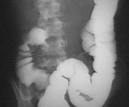 Рентгеноскопия: дефект наполнения при раке правой трети поперечной ободочной кишки